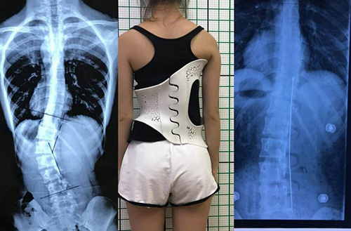 3D打印技術在骨科的實際應用有哪些?(圖4) 3D打印技術在骨科的實際應用有哪些?(圖4)